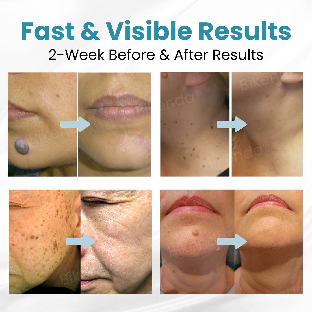 Bikenda® Non-invasive Mole and Wart ✅ 𝕤𝕒𝕧𝕖 𝕦𝕡 𝕥𝕠 𝟟𝟘% Removal Laser Pen