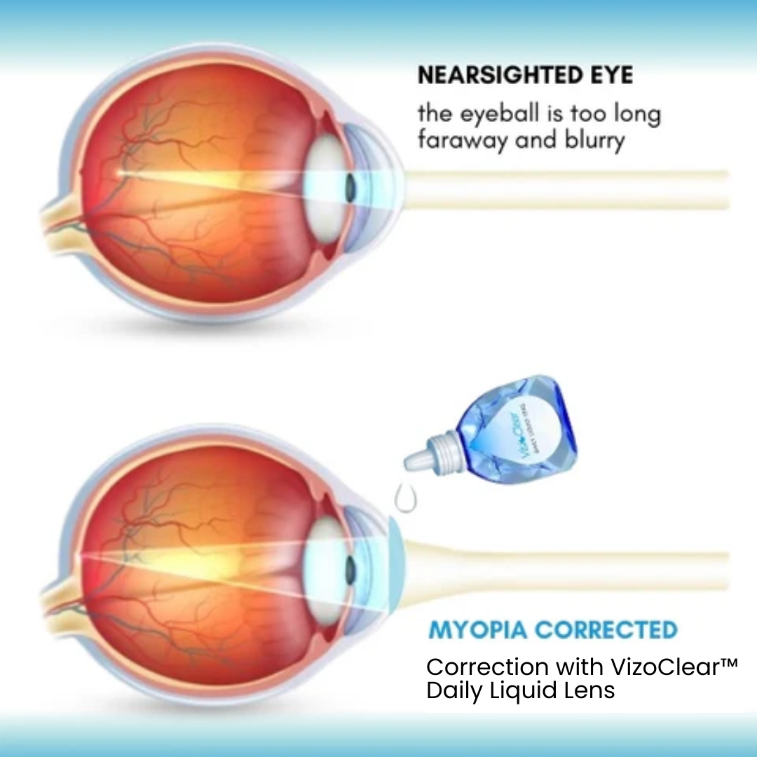 VizoClear™ Daily Liquid Lens - 👩⚕️ Recommended by Experts! 🔥 30-Days Money-Back Guarantee! 💰