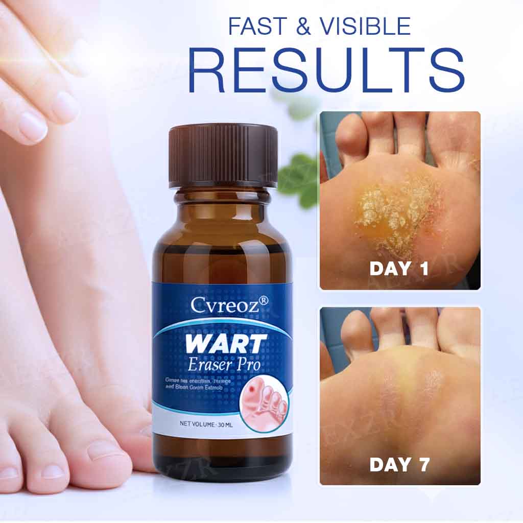 🔥Warts No More - 50% OFF | Cvreoz® Wart Eraser Pro