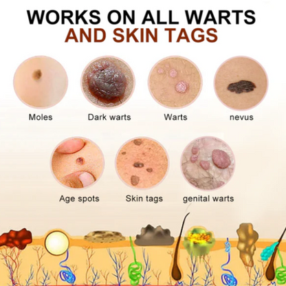 Cvreoz® Bee Venom Mole and Wart Treatment Cream - LIMITED-TIME OFFER | Let out the Best Confidence in YOU!💕