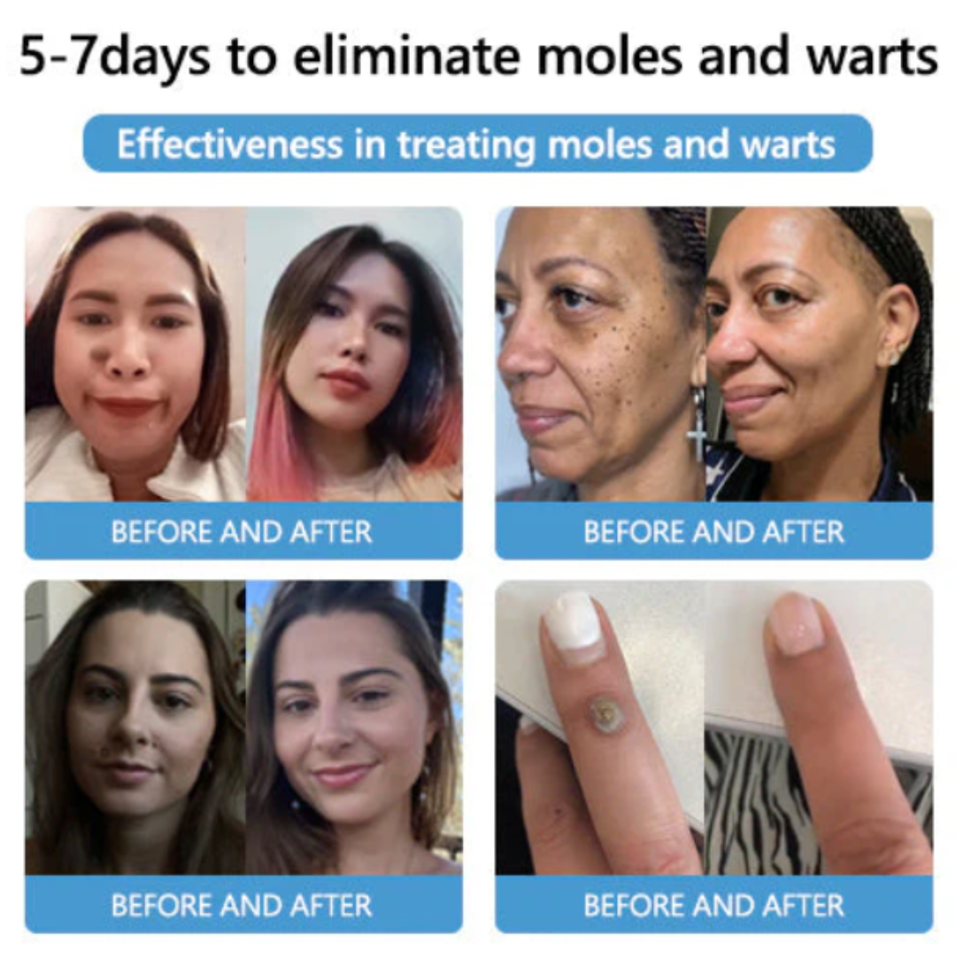 Cvreoz® Bee Venom Mole and Wart Treatment Cream - LIMITED-TIME OFFER | Let out the Best Confidence in YOU!💕