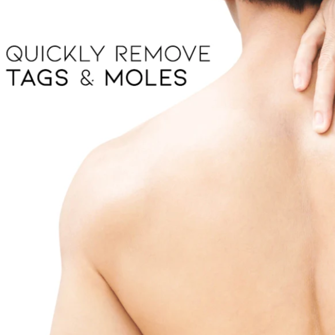 Cvreoz® Bee Venom Mole and Wart Treatment Cream - LIMITED-TIME OFFER | Let out the Best Confidence in YOU!💕