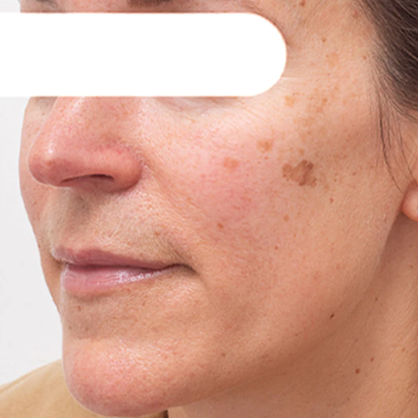 AEXZR® Herbal Spots Peel-Off Facial Mask | LIMITED DISCOUNT OFFER✨