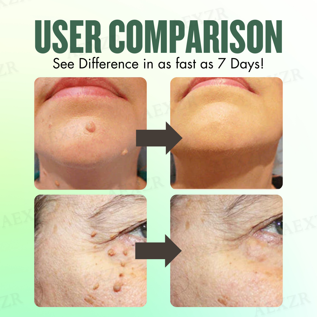 🌟 Official Store | AEXZR® WartsOff Instant Blemish Removal Cream | 50% LIMITED DISCOUNT OFFER✨