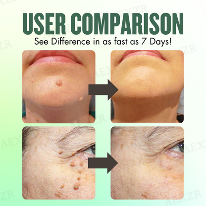 🌟 Official Store | AEXZR® WartsOff Instant Blemish Removal Cream | 50% LIMITED DISCOUNT OFFER✨