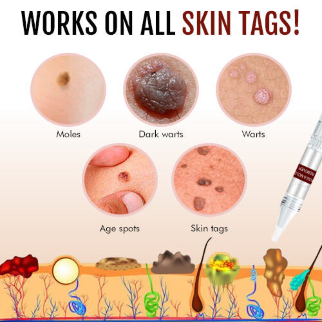 🎁🎁LIMITED DISCOUNT UP TO 50% OFF🎁AEXZR™ Tags & Moles Remover