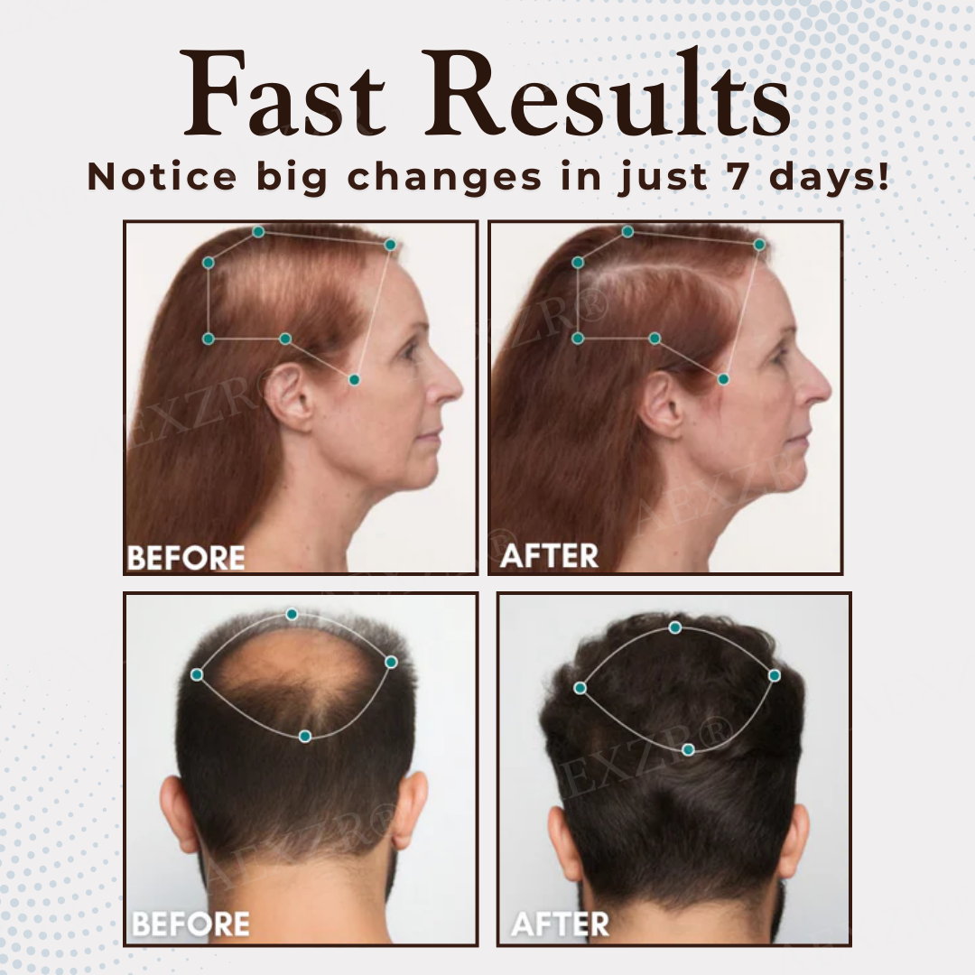 AEXZR® Hair Regrowth Capsules - LIMITED-TIME OFFER | No More Hair loss now!💕