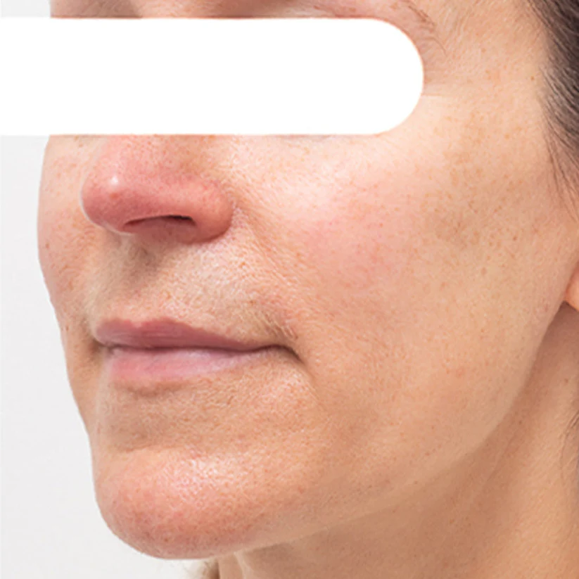 AEXZR® Herbal Spots Peel-Off Facial Mask | LIMITED DISCOUNT OFFER✨