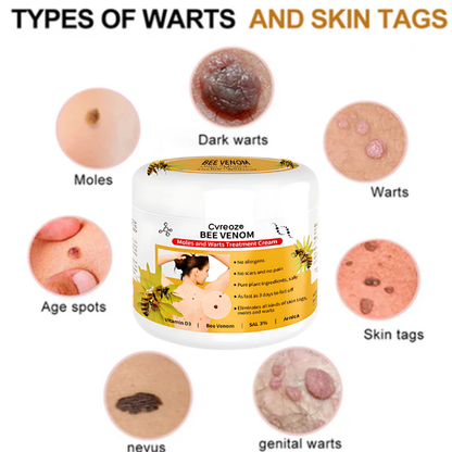 Cvreoz® Bee Venom Mole and Wart Treatment Cream - LIMITED-TIME OFFER | Let out the Best Confidence in YOU!💕