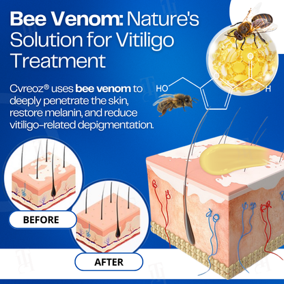 Cvreoz® VitiClear Bee Venom Cream | No More Hiding that Skin!💕